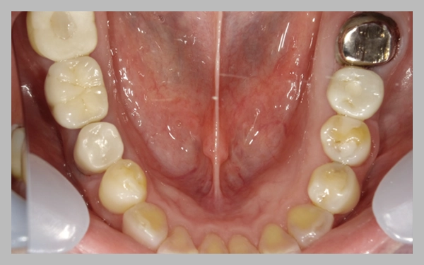 インプラント症例写真2【治療後】