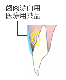 歯肉漂白の治療方法