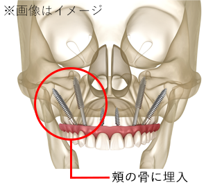 骨量が足りない方にザイゴマインプラント