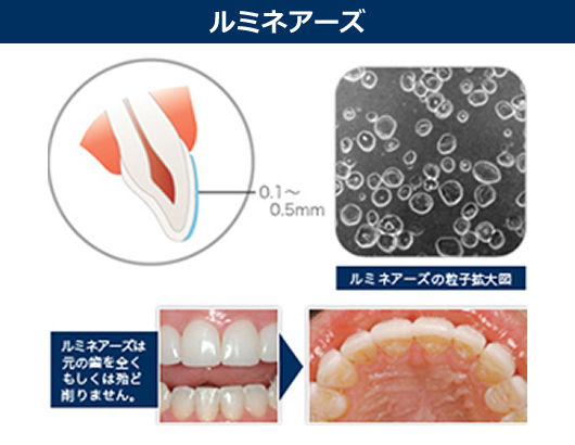 「ルミネアーズ」と「ラミネートベニア」の比較