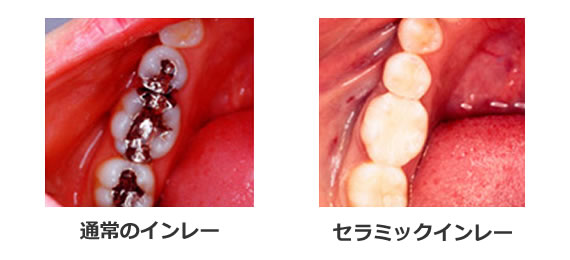 インレーとは