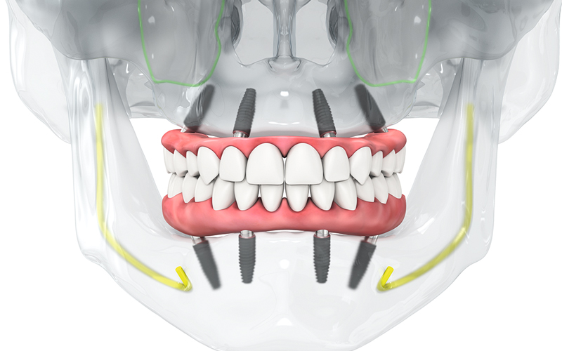 オールオン4とは？メリット・デメリットや治療の流れ、Q&Aを解説！