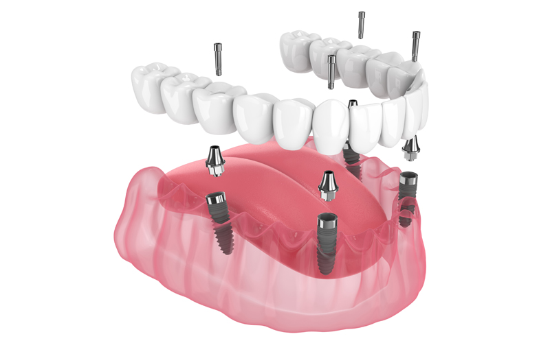 コストを抑えたオールオン4で、インプラント治療を受けよう！