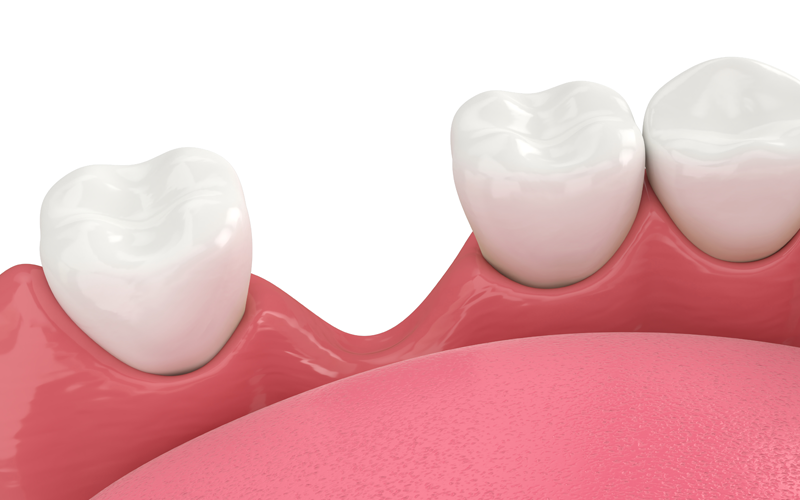 歯が抜けた後の応急処置は？素材ごとの特徴やメリット・デメリットを解説！
