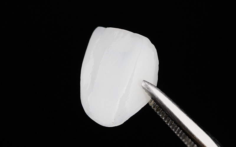 セラミック歯の特徴